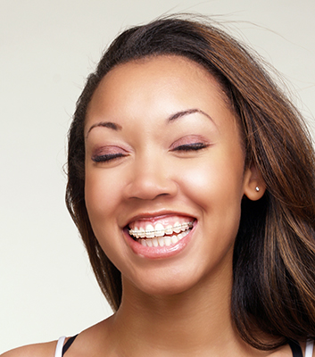 Ceramic braces