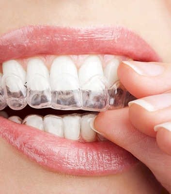 Invisalign