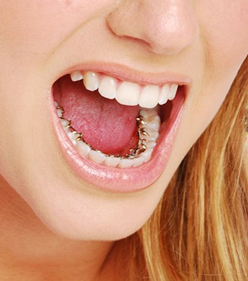 Lingual Hidden Braces | Bauer Orthodontics