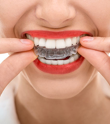 Why Invisalign?